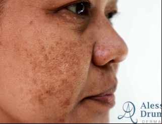 Melasma sob controle: Tratamento inovador revoluciona a pele!
