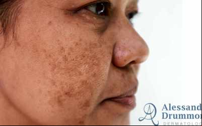 Melasma sob controle: Tratamento inovador revoluciona a pele!